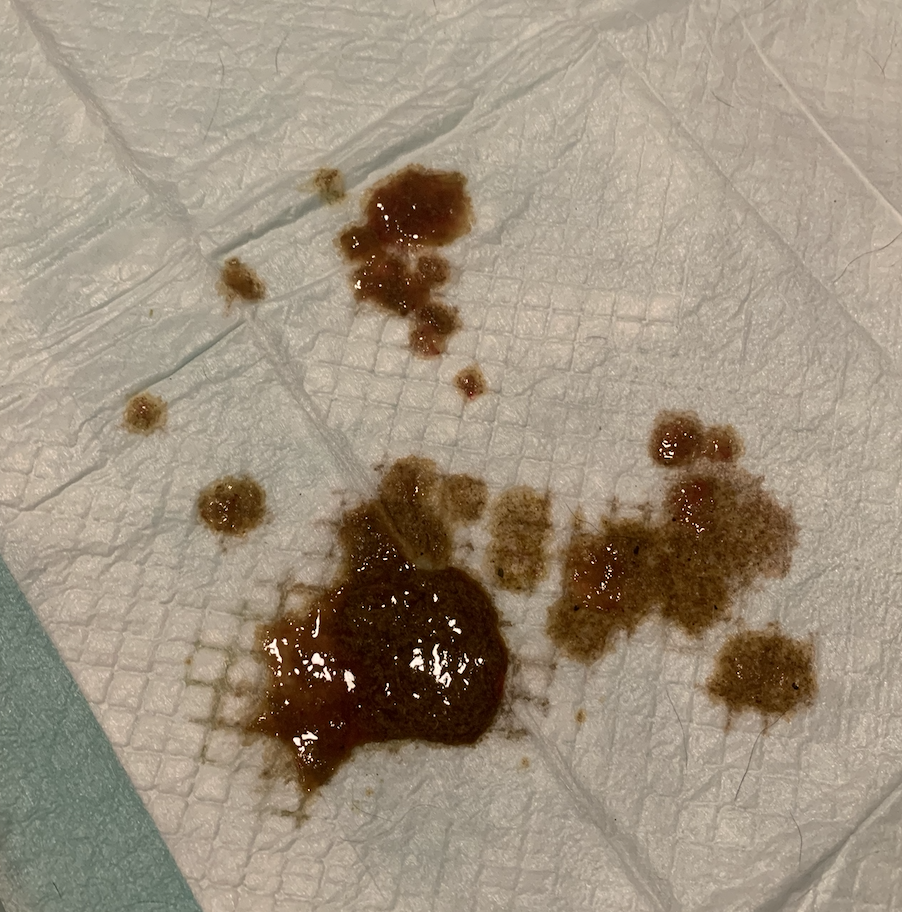 Bloody Diarrhea